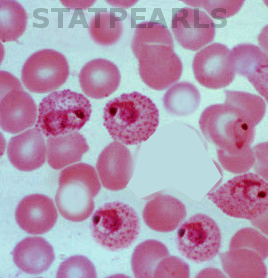 Blood smear malaria