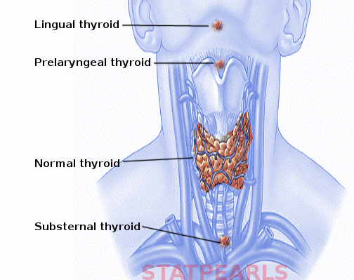 Ectopic thyroid