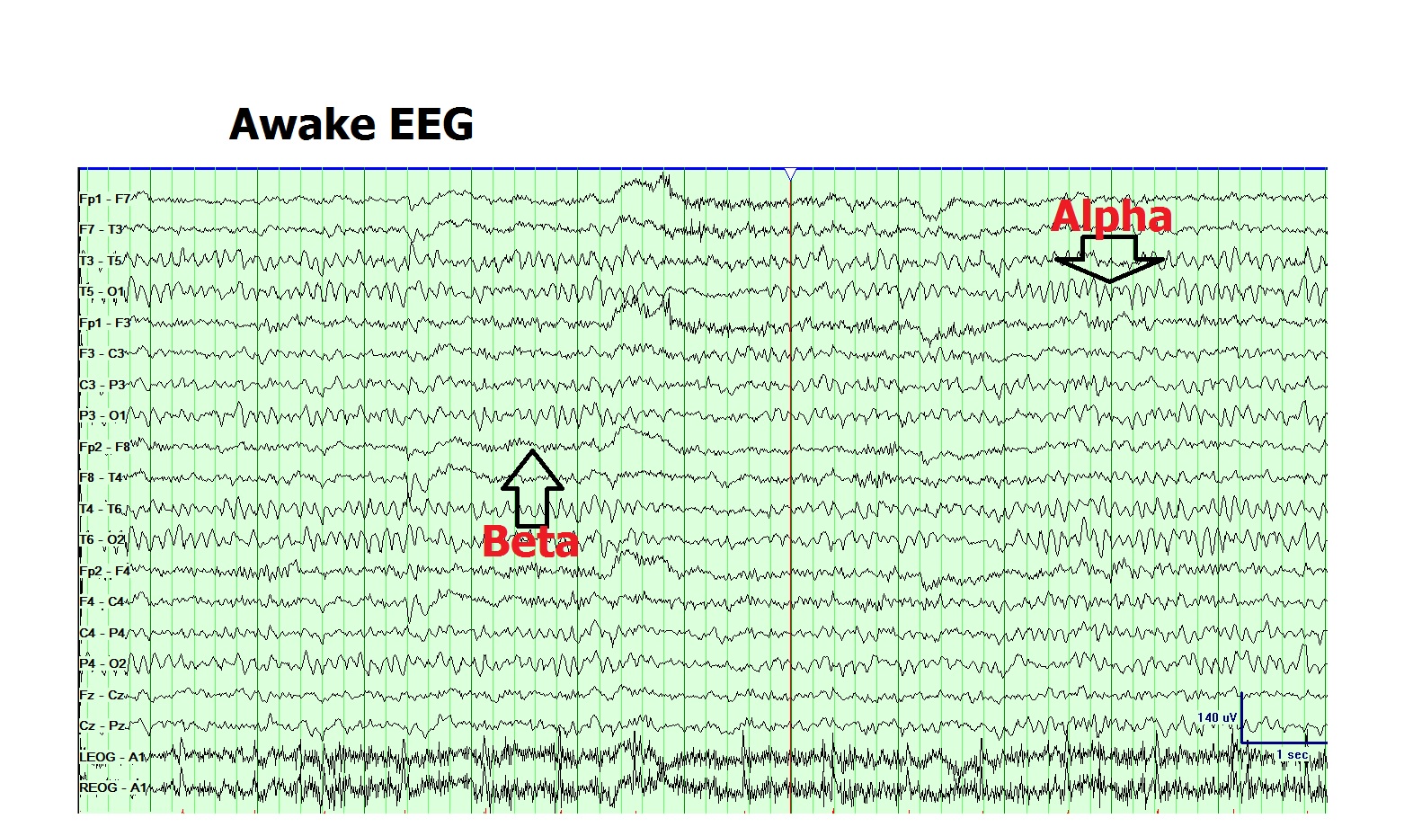 Normal Awake EEG