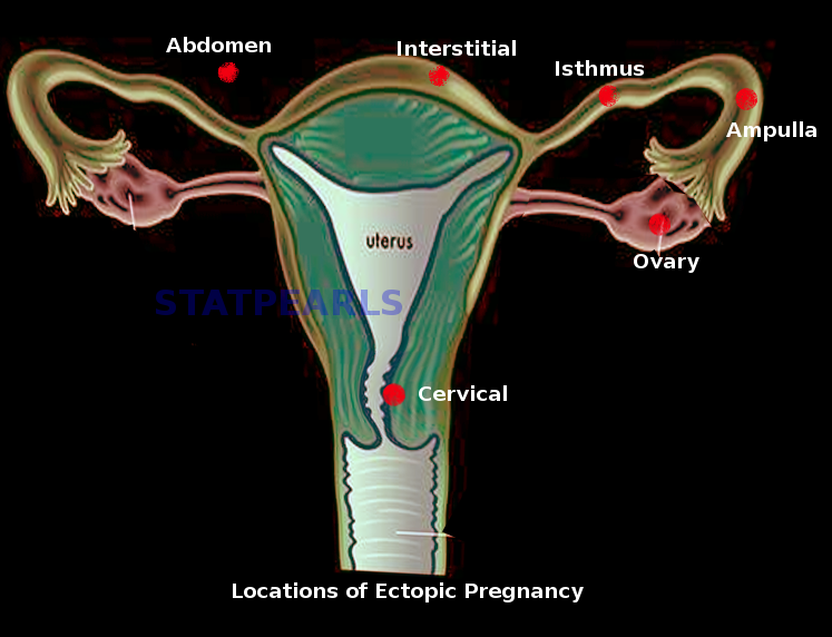 Locations of ectopic pregnancies