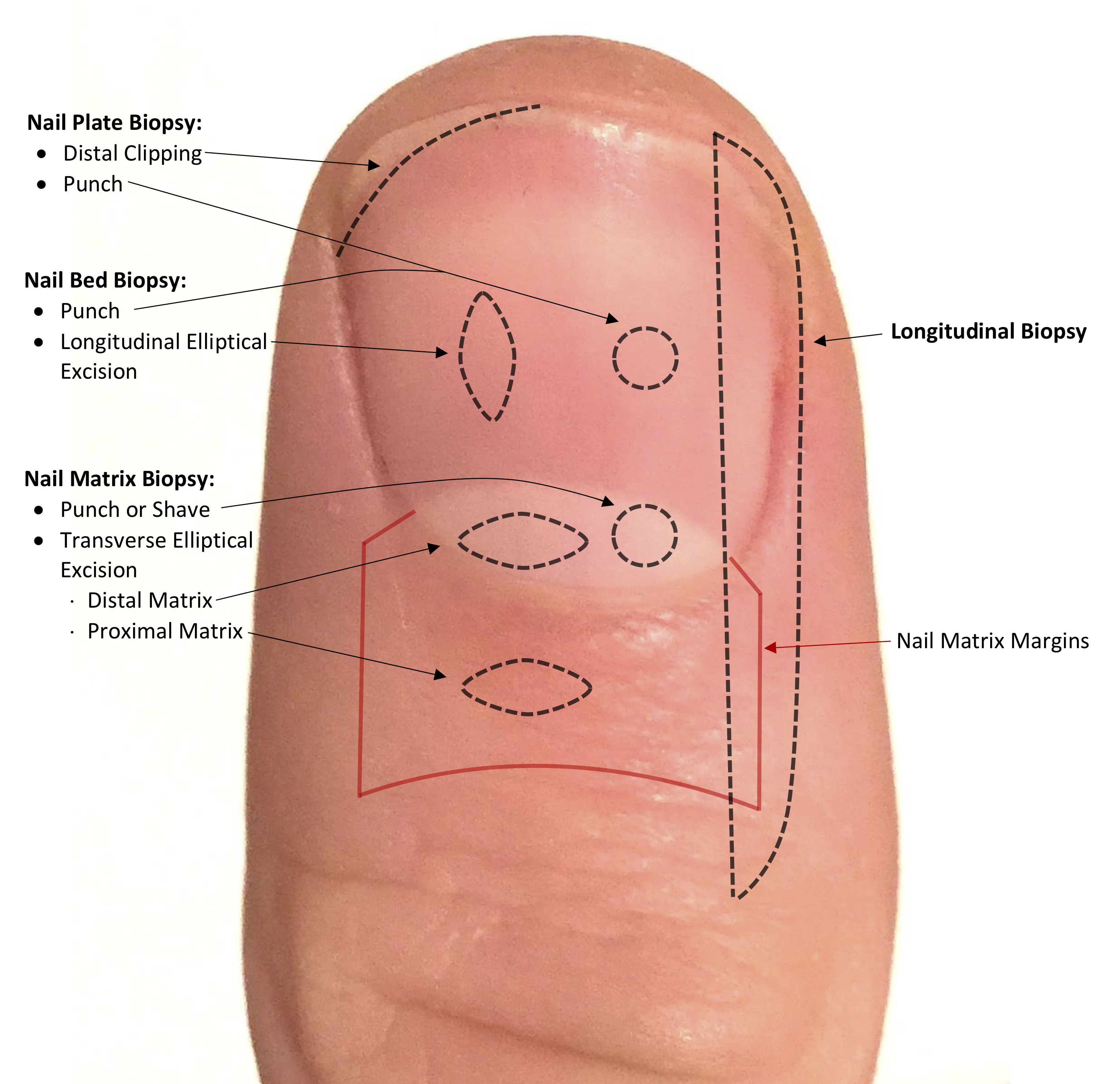 Location and orientation of nail biopsies.