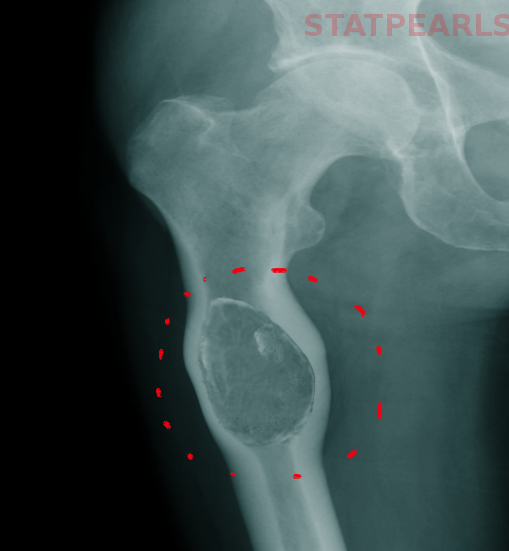 Bone cyst in proximal femur