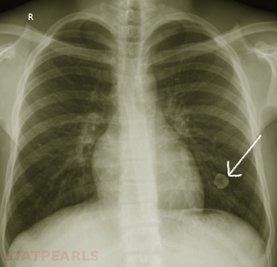 Lung hamartoma