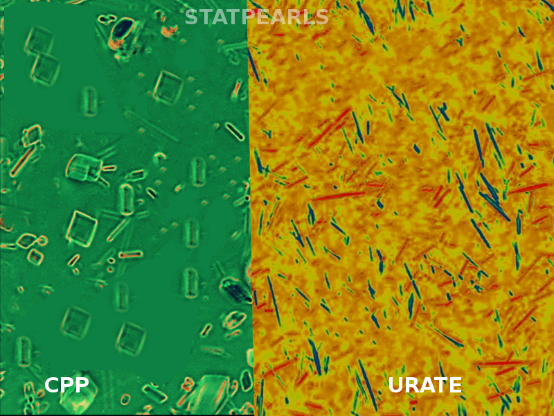 CPP and Urate crystals