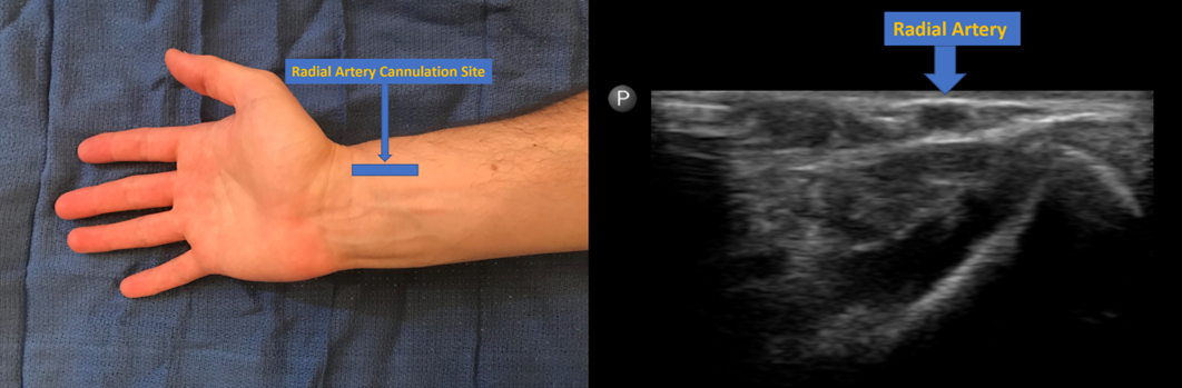 Radial artery cannulation site and image of radial artery on ultrasound at this level. 