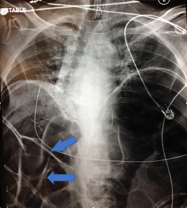 Rigler sign and massive free air on chest radiograph after intubation. 