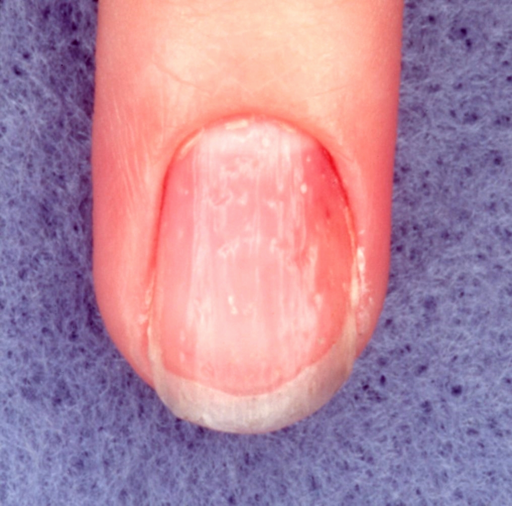 Nail pitting as seen in a Psoriasis patient