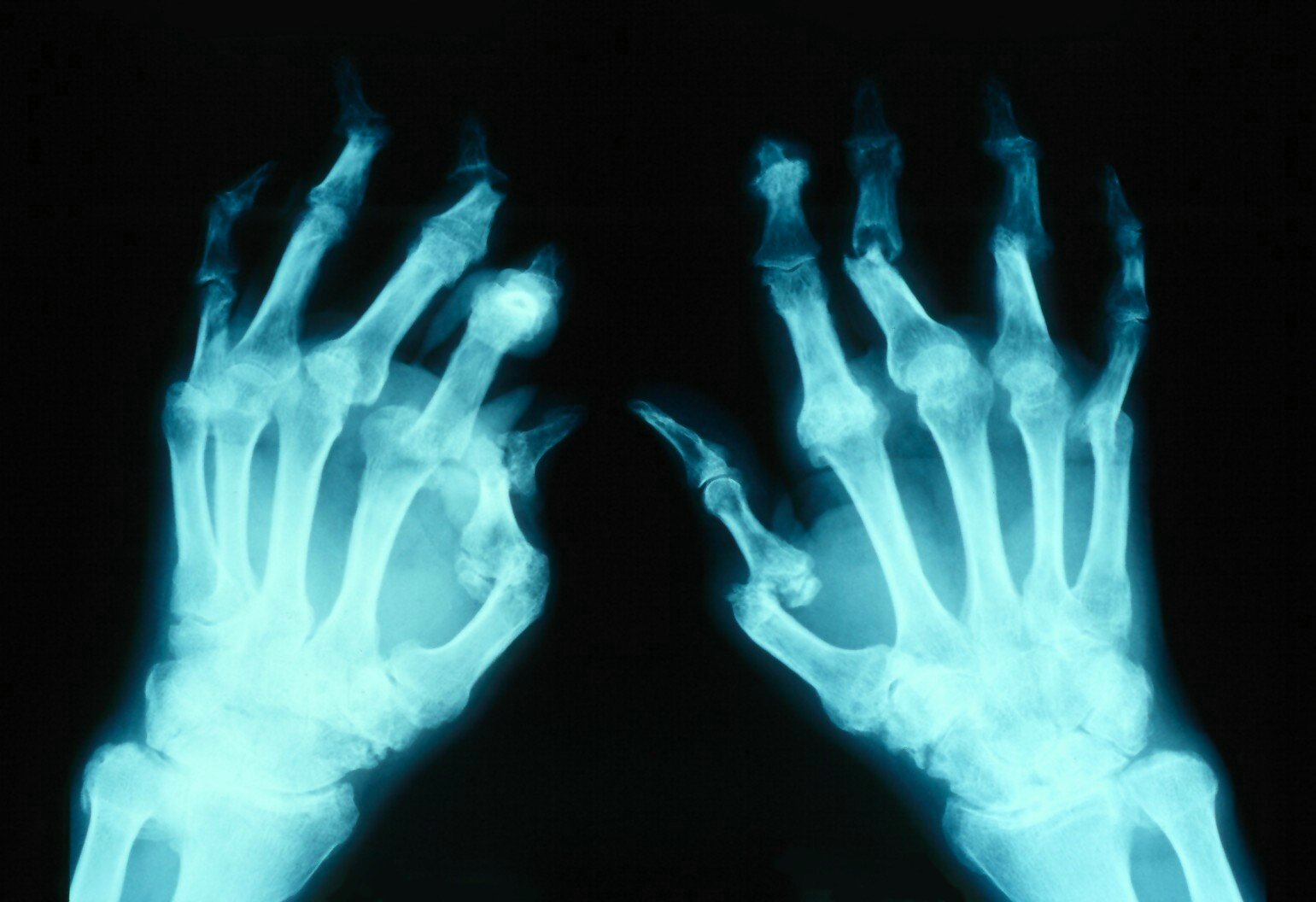 An X-ray of Arthritis Mutilans of hands