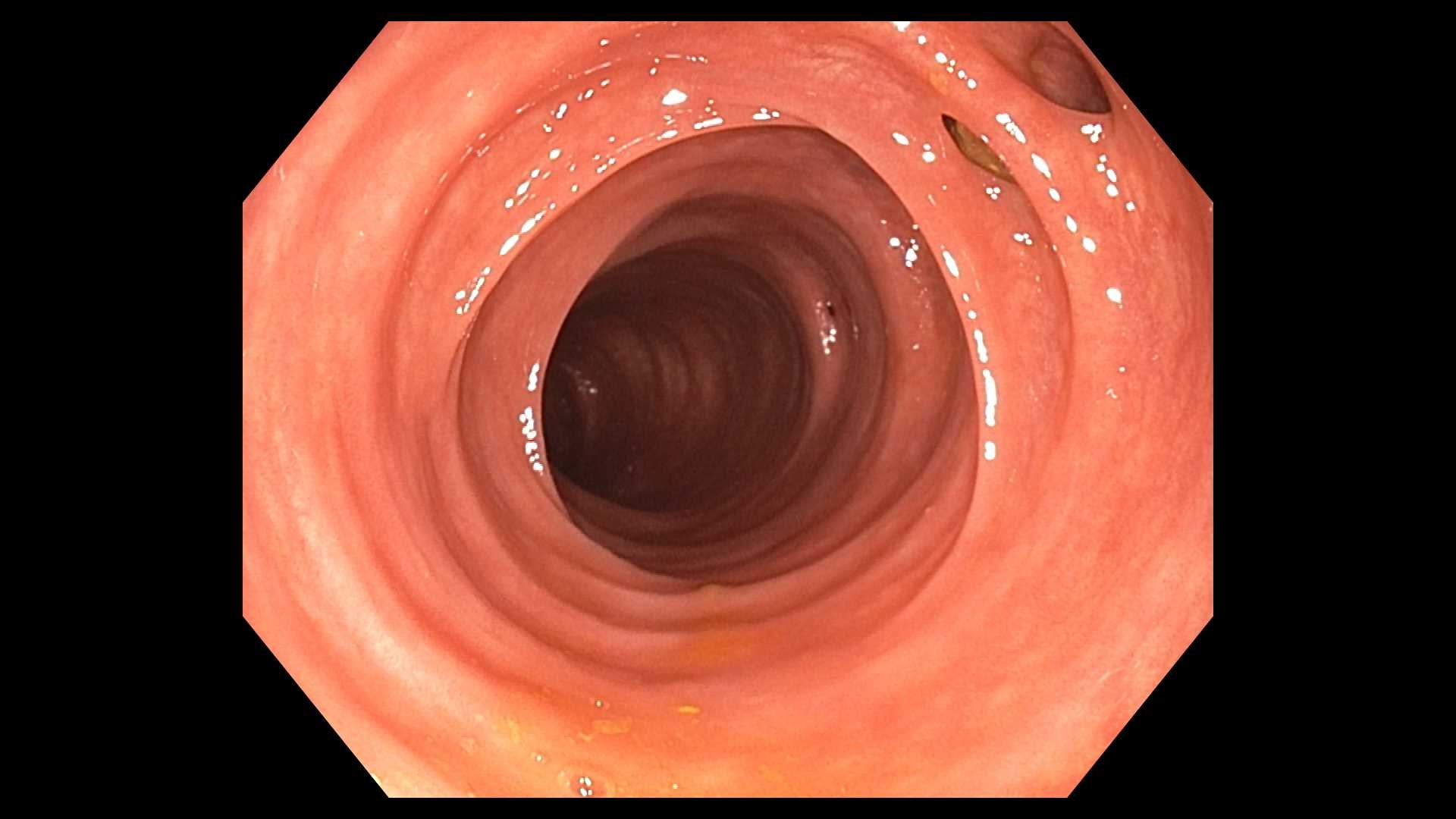 Diverticulosis on colonoscopy. 