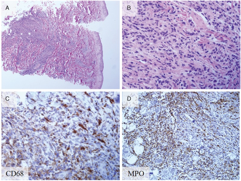 Histopathology and immunohistochemical staining of biopsy from the skin leukemia cutis. (A) Leukemic cell infiltration beneath the epidermis (hematoxylin and eosin stain; original magnification ×40). (B) Magnified view of the leukemic cell infiltration (hematoxylin and eosin stain; original magnification ×400). (C) CD68-positive cells (CD68 staining; original magnification ×400). (D) Myeloperoxidase-positive (MPO) cells (MPO staining; magnification ×400). MPO cells = myeloperoxidase-positive cells.