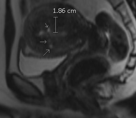 Figure 1: T2-weighted image of adenomyosis. Imaging features of myometrial cysts, globular contour, and a thickened junctional zone measuring >12mm.