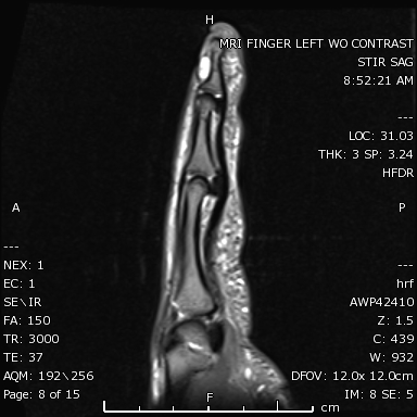 STIR sagittal image of the left index finger demonstrates a markedly hyperintense subungual mass.
