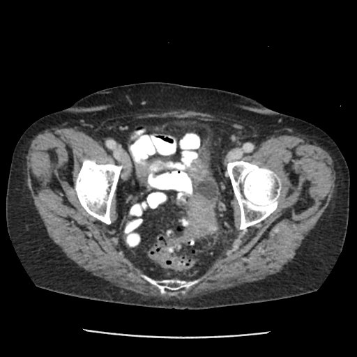 Complicated diverticulitis with abscess