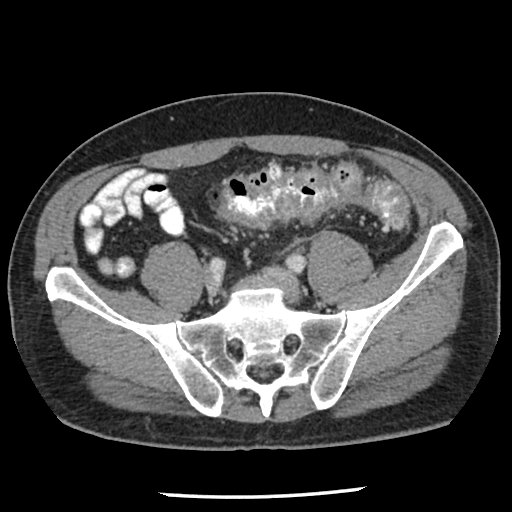 Uncomplicated diverticulitis on CT scan