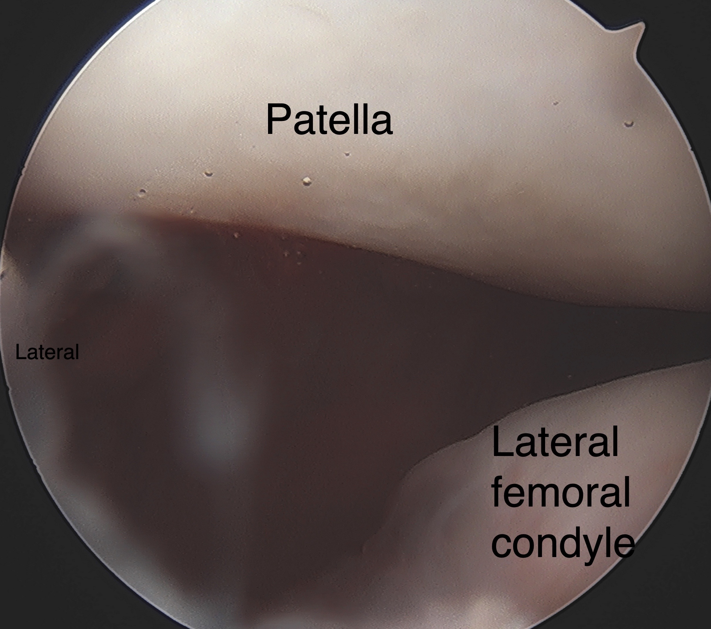 Right knee arthroscopic image demonstrating static lateral patellar subluxation during a diagnostic knee arthroscopy followed by medial patellofemoral ligament reconstruction using semitendinosus allograft tendon