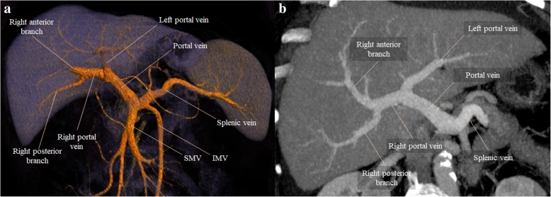 Figure 1.
Normal portal vein branching patterns as visualized by contrast-enhanced CT imaging.