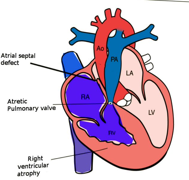 Pulmonary Atresia With Intact Ventricular Septum Article