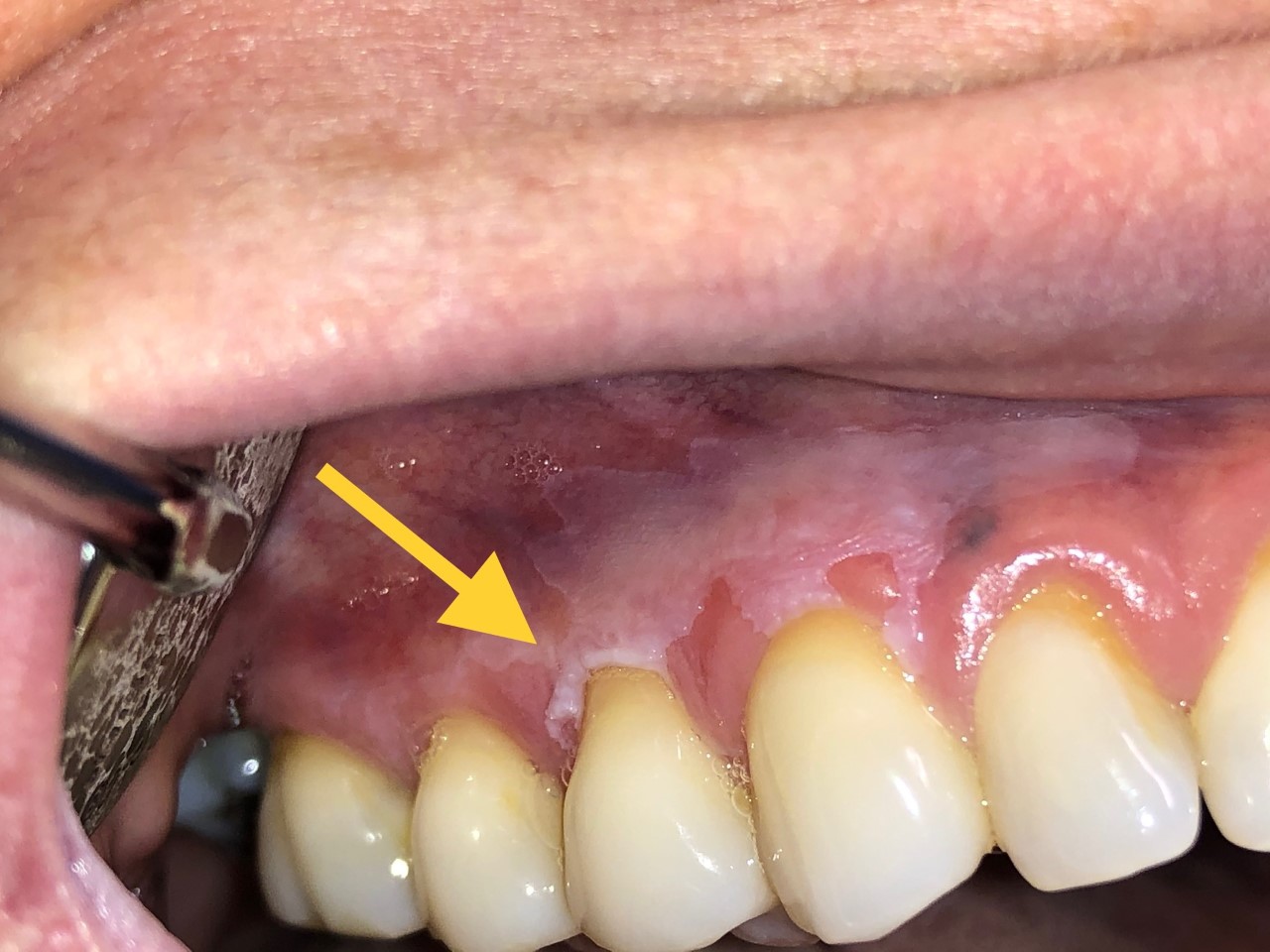 Premalignant Lesions Of The Oral Mucosa Article