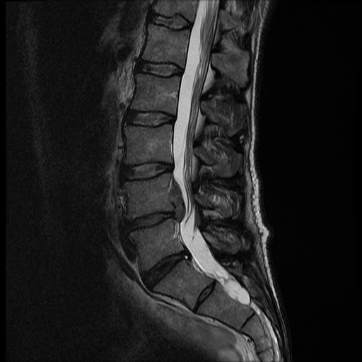 Lumbar Spine Imaging Article - StatPearls