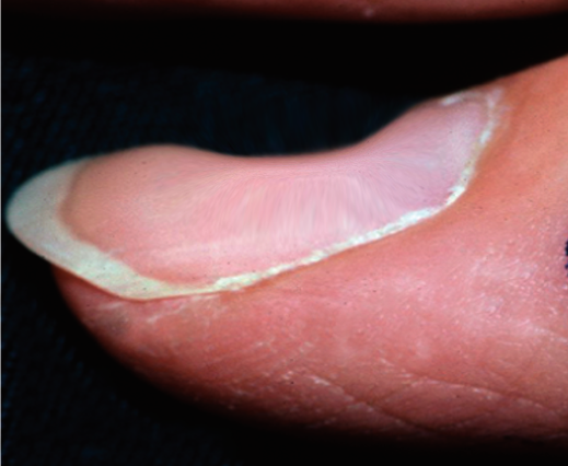 4. Nail Bed Color and Iron Deficiency Anemia - wide 4
