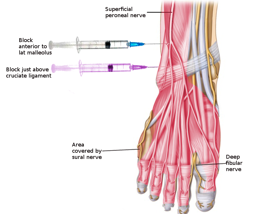 Superficial Peroneal Nerve Block Article Statpearls