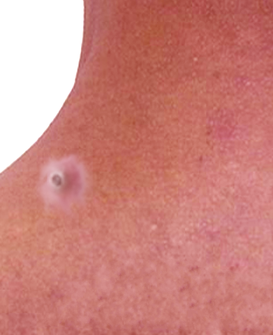 Dilated Pore Of Winer Article