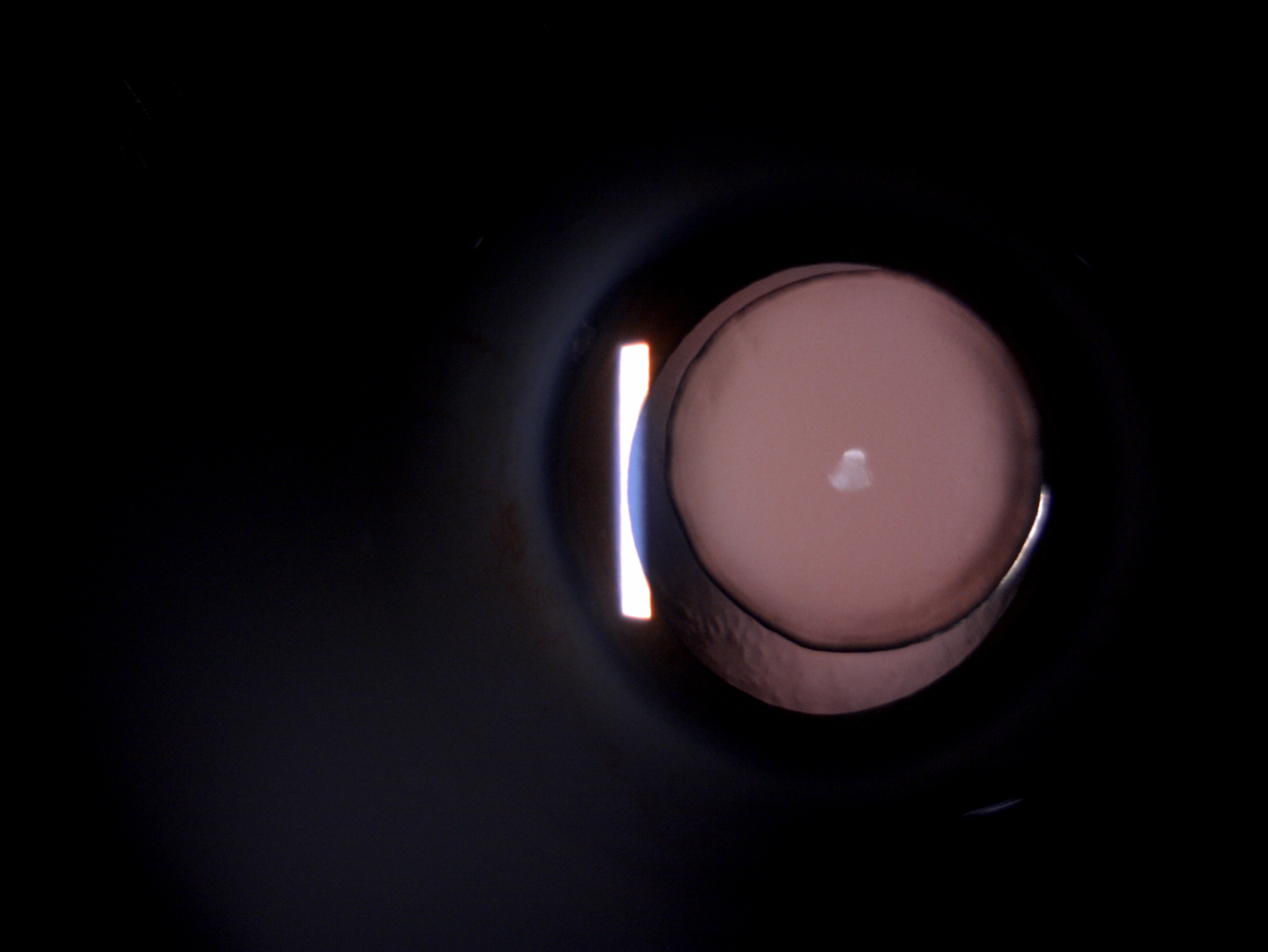 Slit lamp image of the patient depicting microspherophakic lens with ectopia lentis in a patient with Weill-Marchesani syndrome